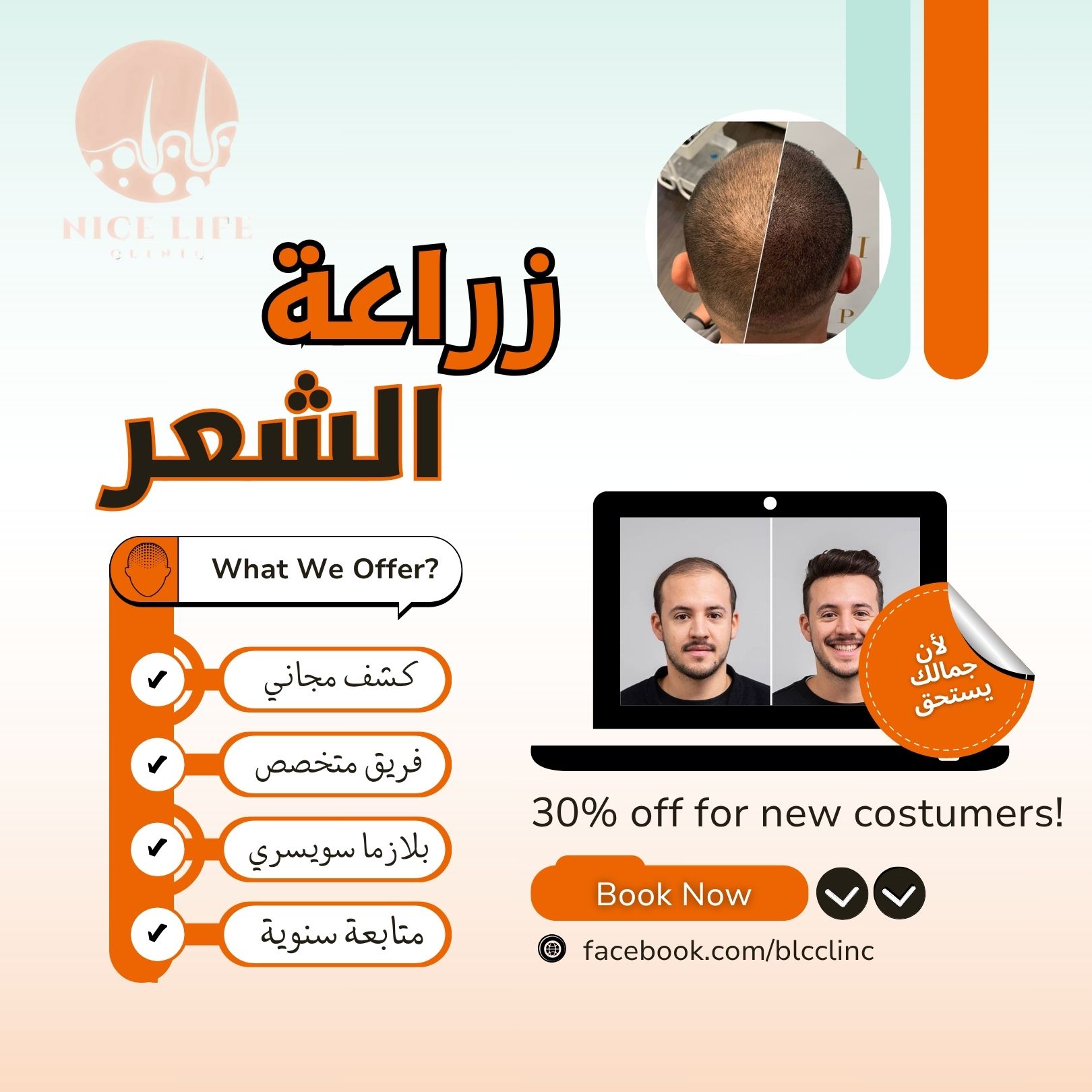 نتيجة عملية زراعة شعر 3